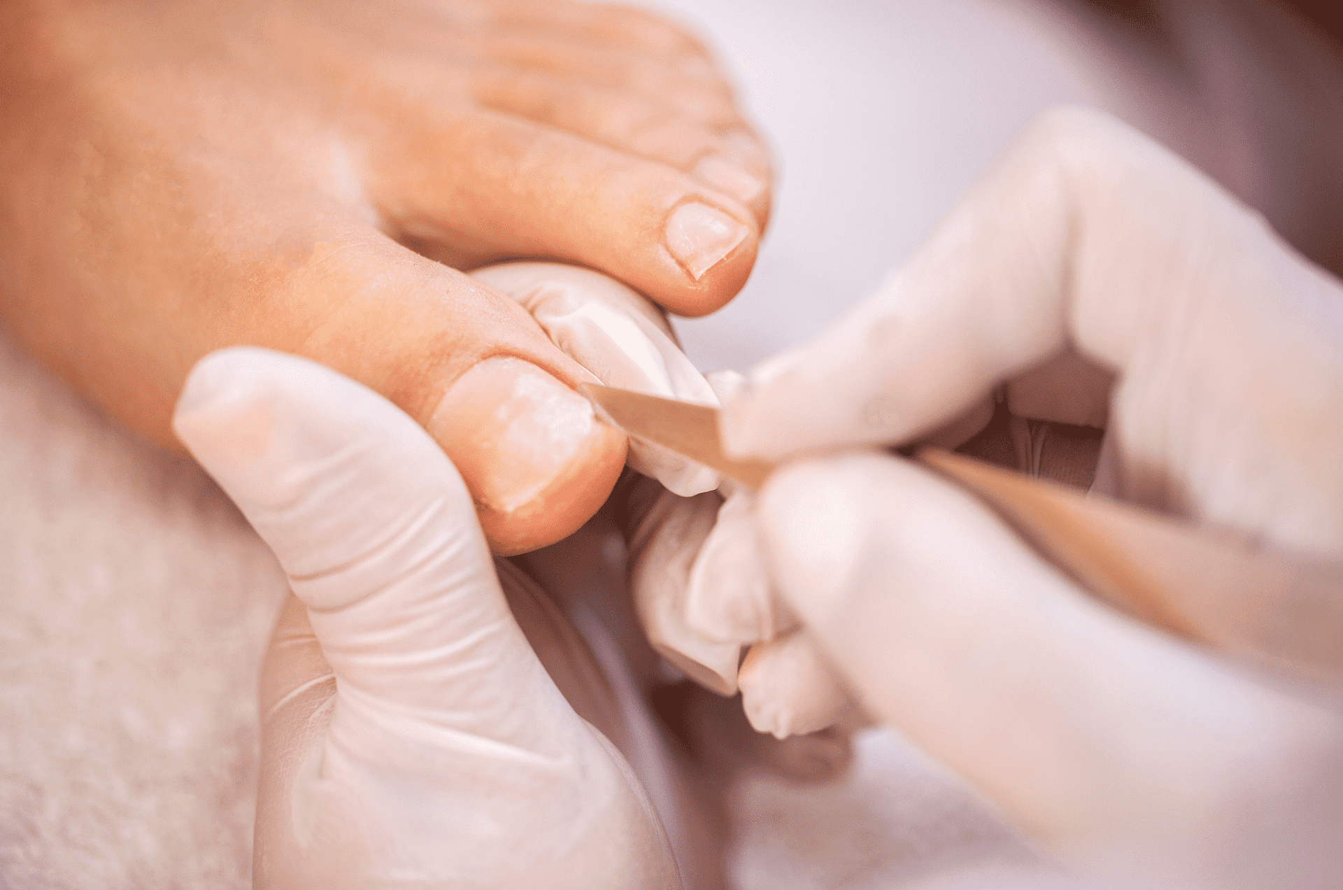 Professional working on an ingrown toe nail